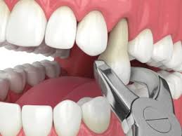 Tooth being pulled but not a wisdom tooth